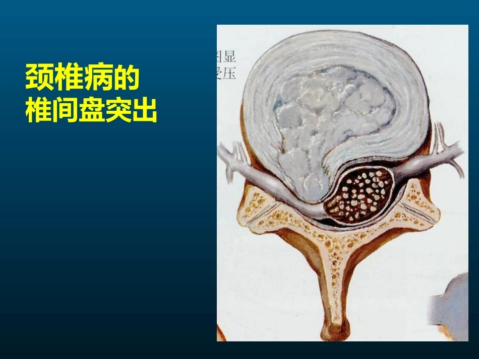 颈椎病的MRI诊断(2)_第14页