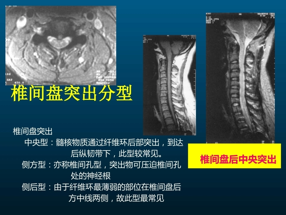 颈椎病的MRI诊断(2)_第15页