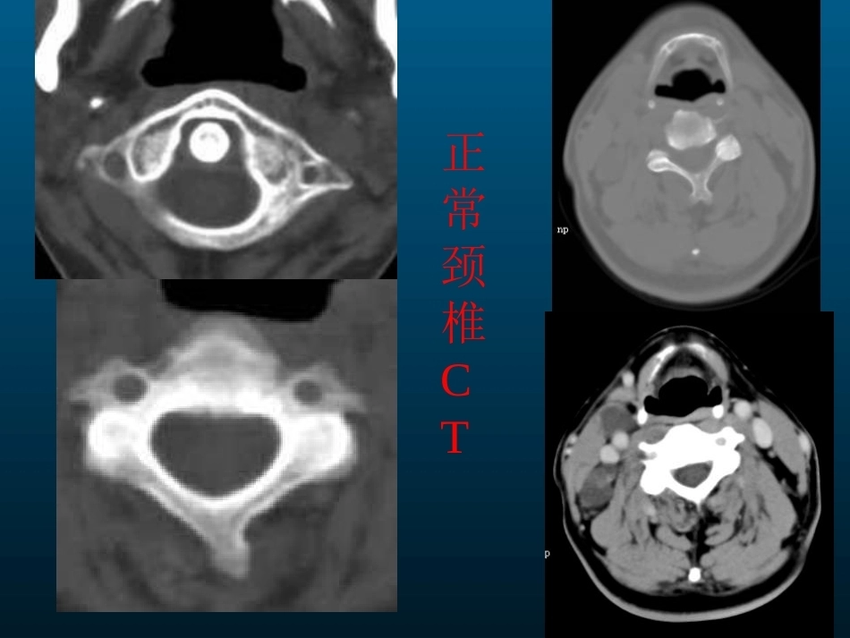 颈椎病的MRI诊断(2)_第7页