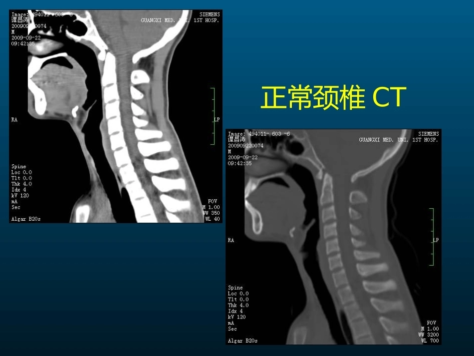 颈椎病的MRI诊断(2)_第8页