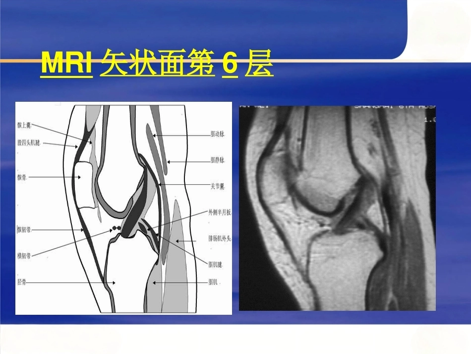 膝关节MRI(2)_第10页