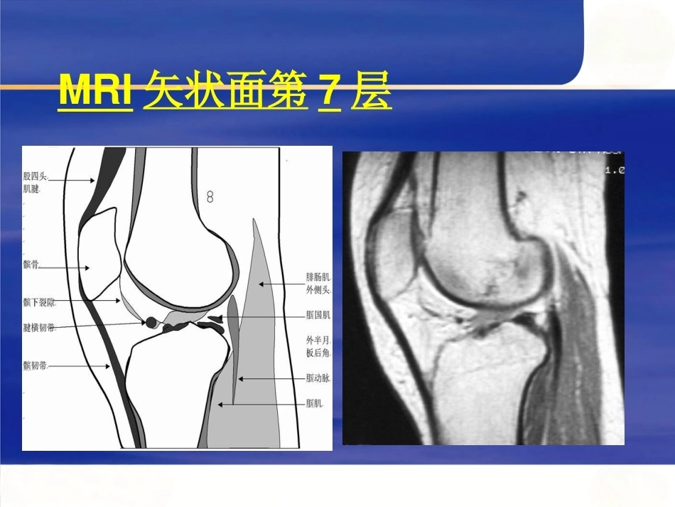 膝关节MRI(2)_第11页