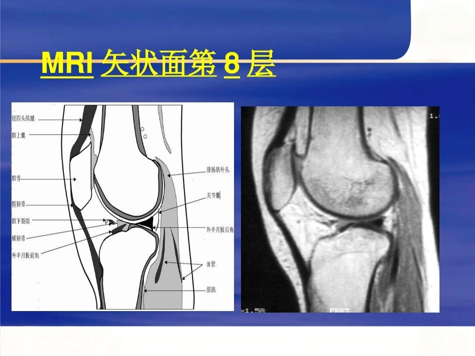 膝关节MRI(2)_第12页