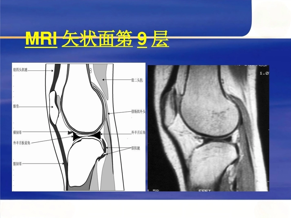 膝关节MRI(2)_第13页