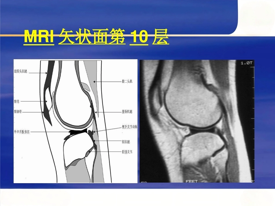 膝关节MRI(2)_第14页