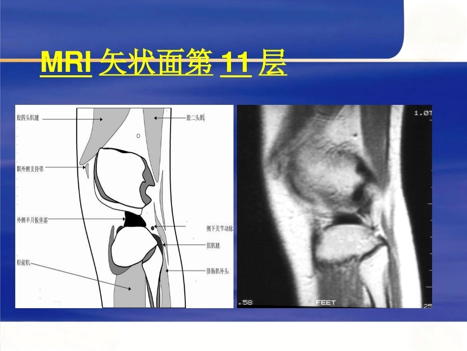 膝关节MRI(2)_第15页