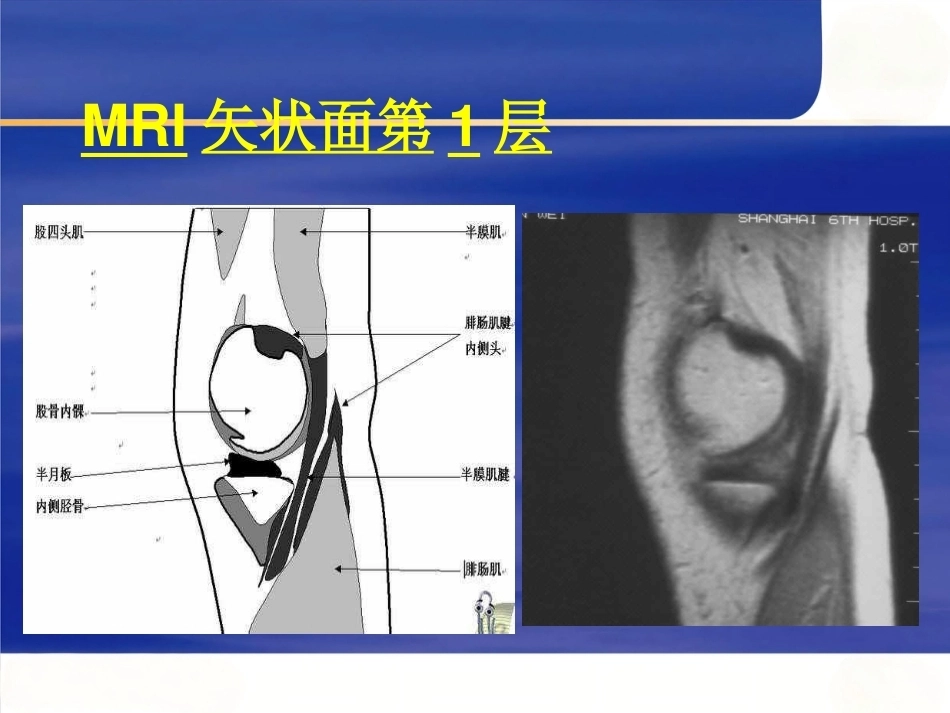 膝关节MRI(2)_第5页