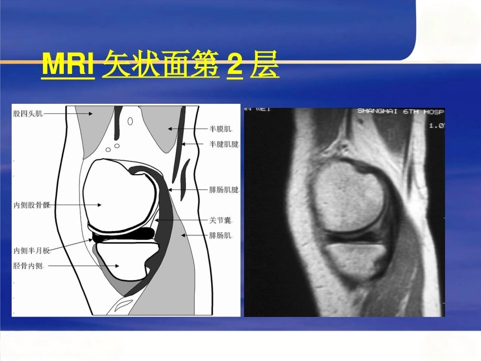 膝关节MRI(2)_第6页
