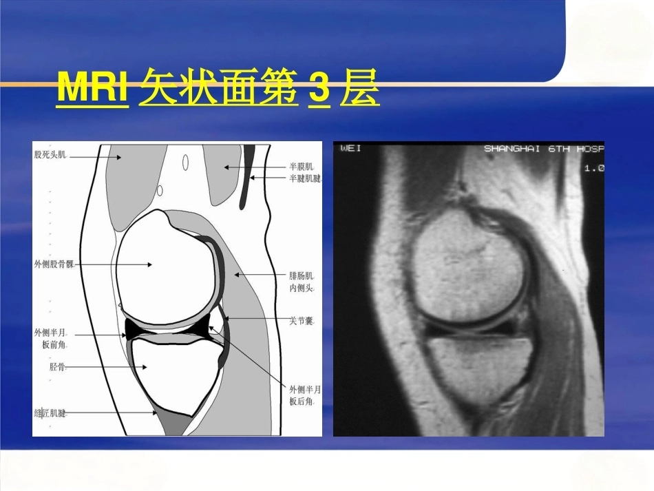 膝关节MRI(2)_第7页