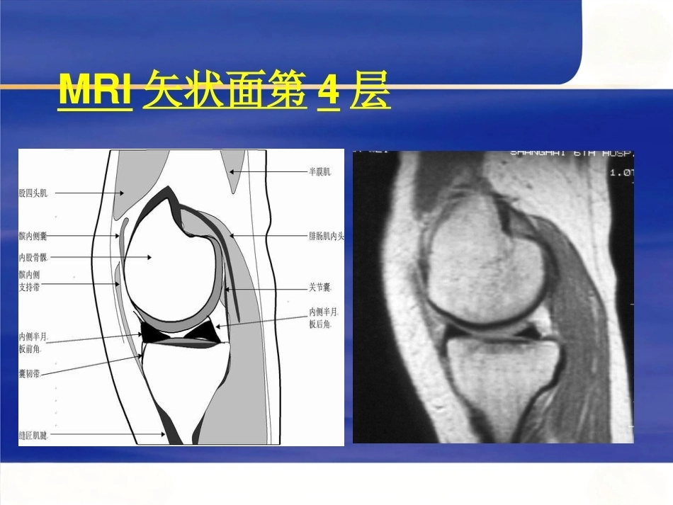 膝关节MRI(2)_第8页