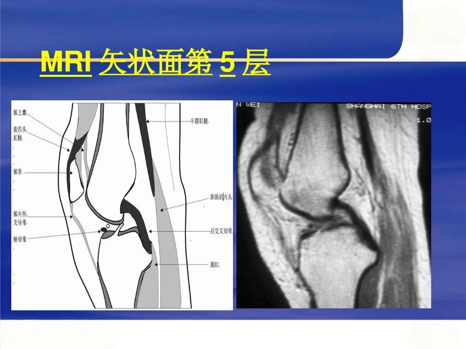 膝关节MRI(2)_第9页