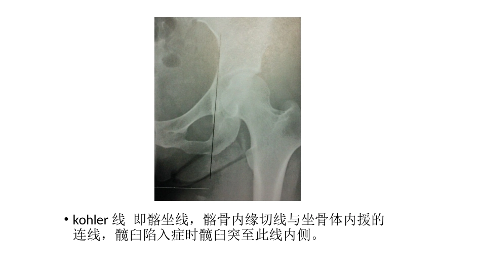 髋关节角度测量(2)_第15页
