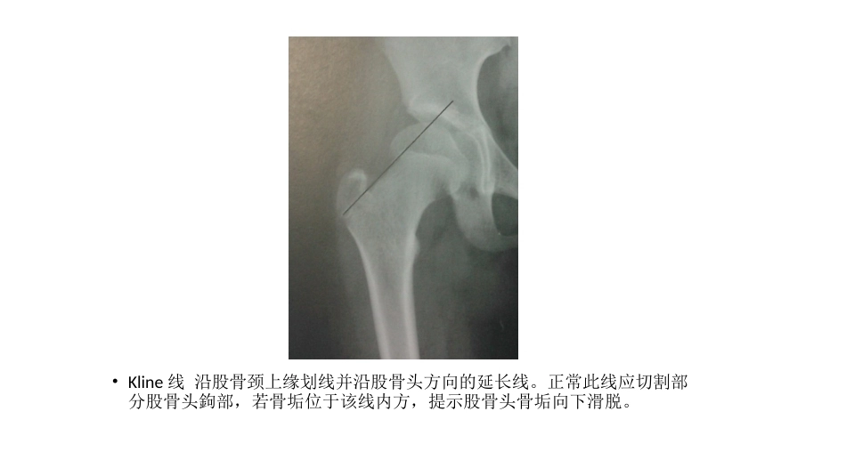 髋关节角度测量(2)_第8页