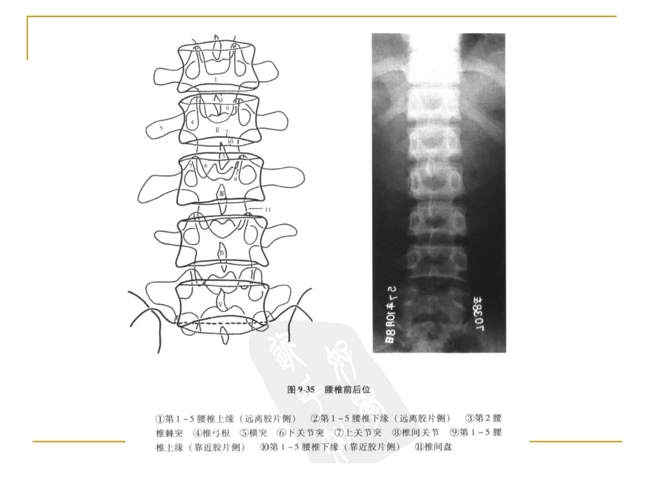 脊柱x片诊断(2)_第11页