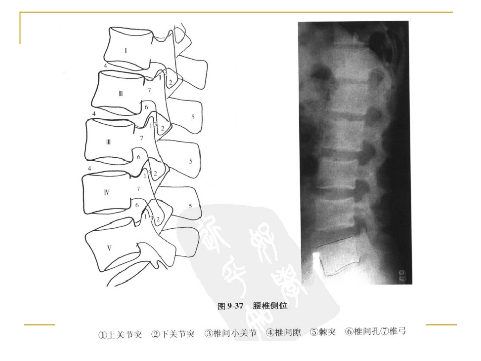 脊柱x片诊断(2)_第12页