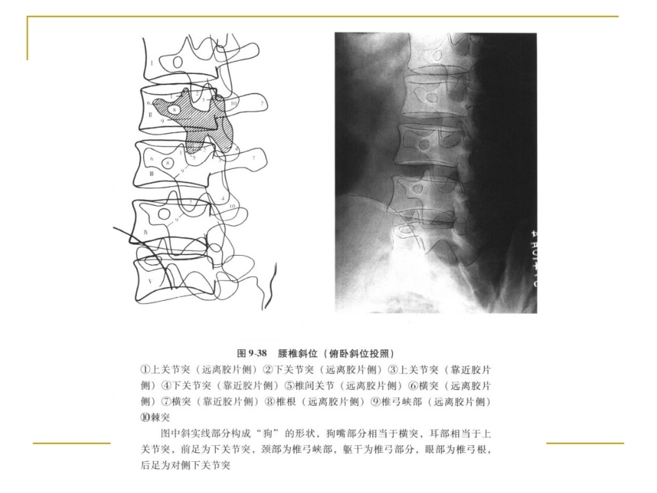 脊柱x片诊断(2)_第13页