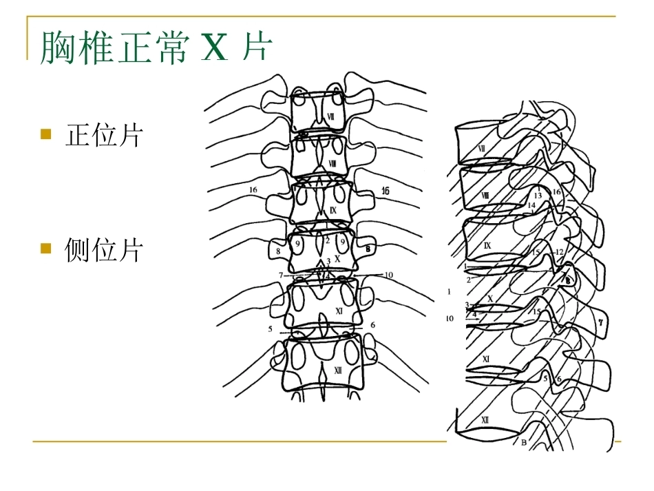 脊柱x片诊断(2)_第4页