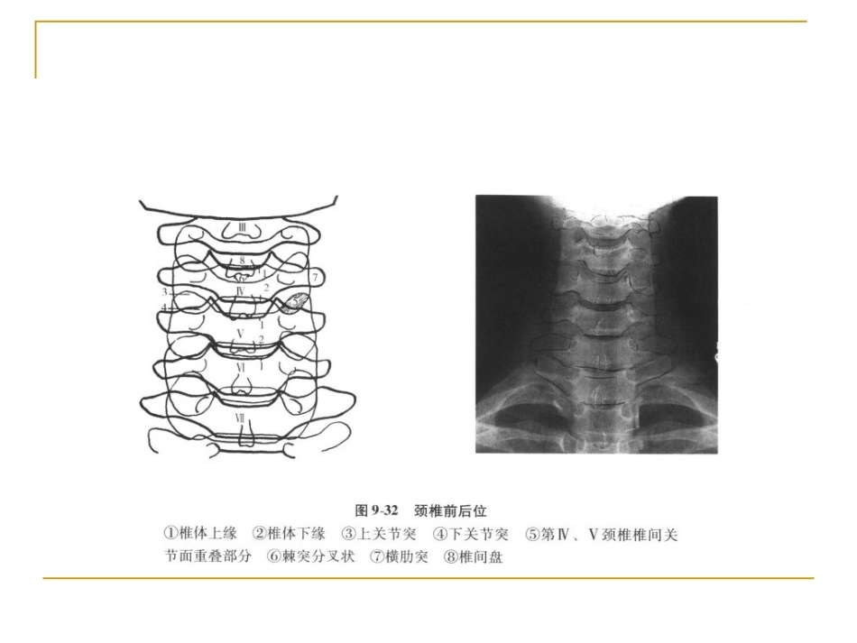 脊柱x片诊断(2)_第6页