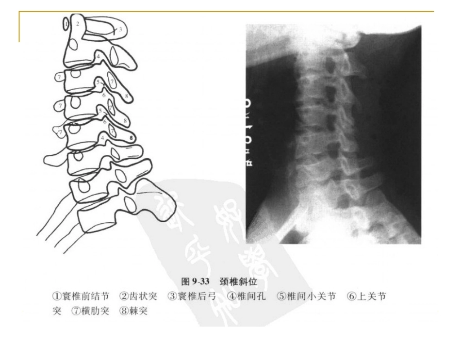 脊柱x片诊断(2)_第8页