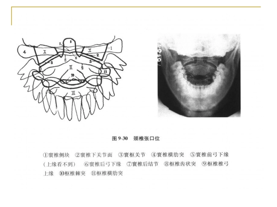 脊柱x片诊断(2)_第9页