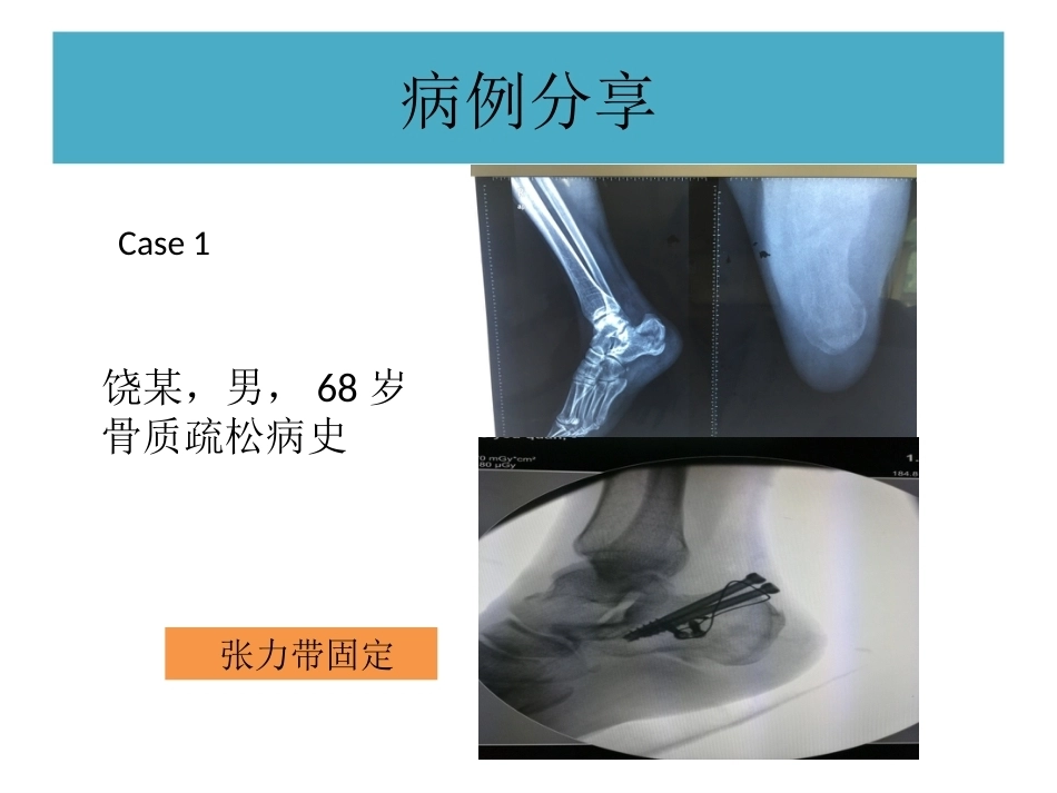 跟骨结节骨折 (2)_第13页