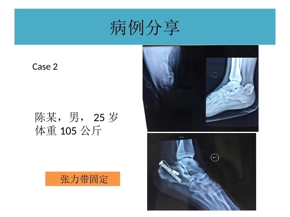 跟骨结节骨折 (2)_第14页