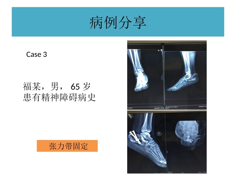 跟骨结节骨折 (2)_第15页