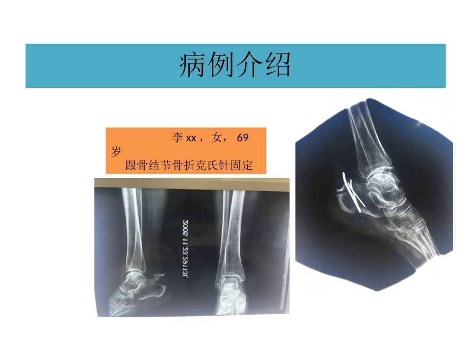 跟骨结节骨折 (2)_第2页