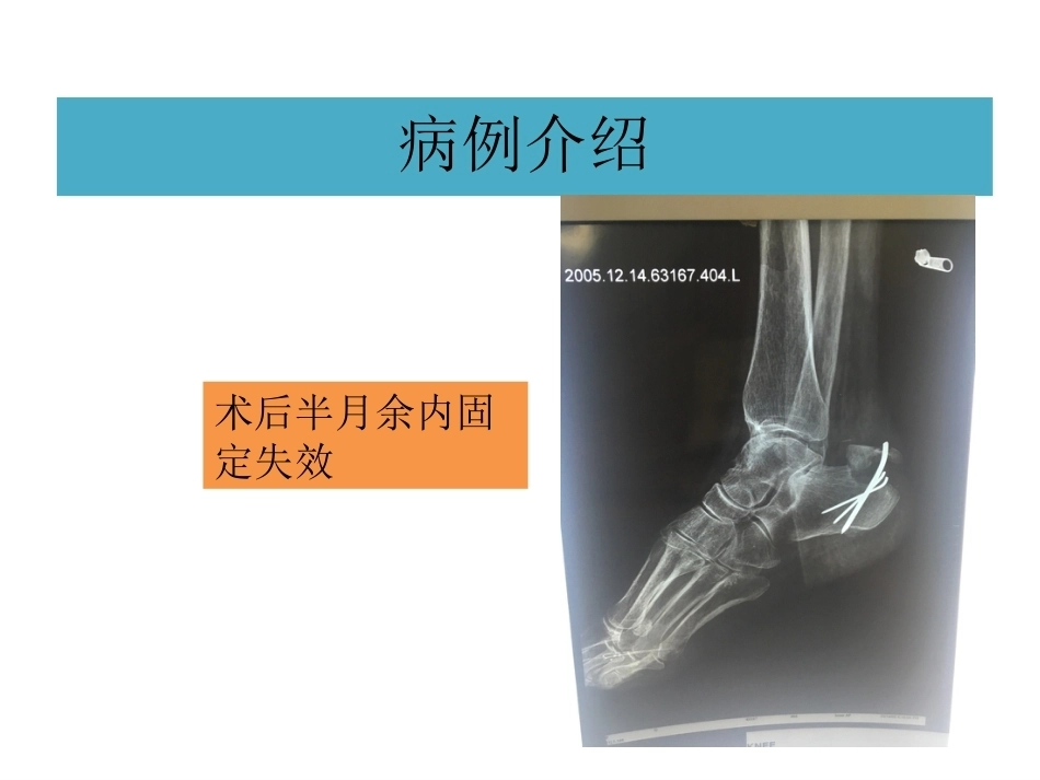 跟骨结节骨折 (2)_第3页