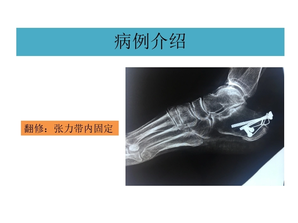 跟骨结节骨折 (2)_第4页