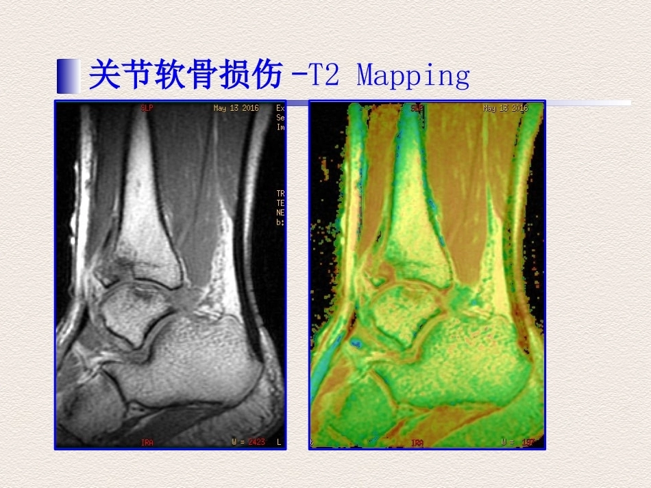 踝关节运动损伤MR诊断(2)_第10页