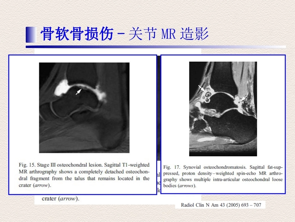 踝关节运动损伤MR诊断(2)_第13页