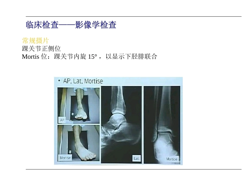 踝关节骨折(2)_第12页