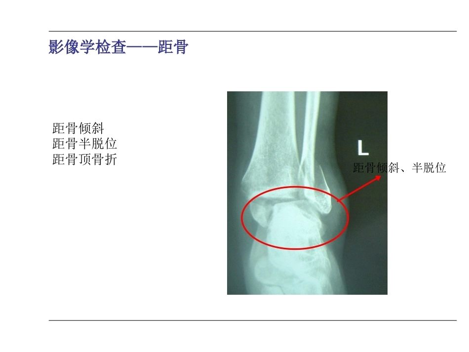 踝关节骨折(2)_第14页