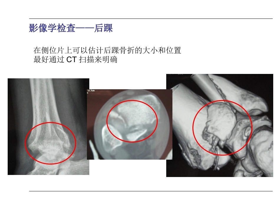 踝关节骨折(2)_第15页