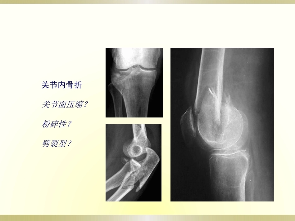 初学者必看骨科读片(2)_第11页