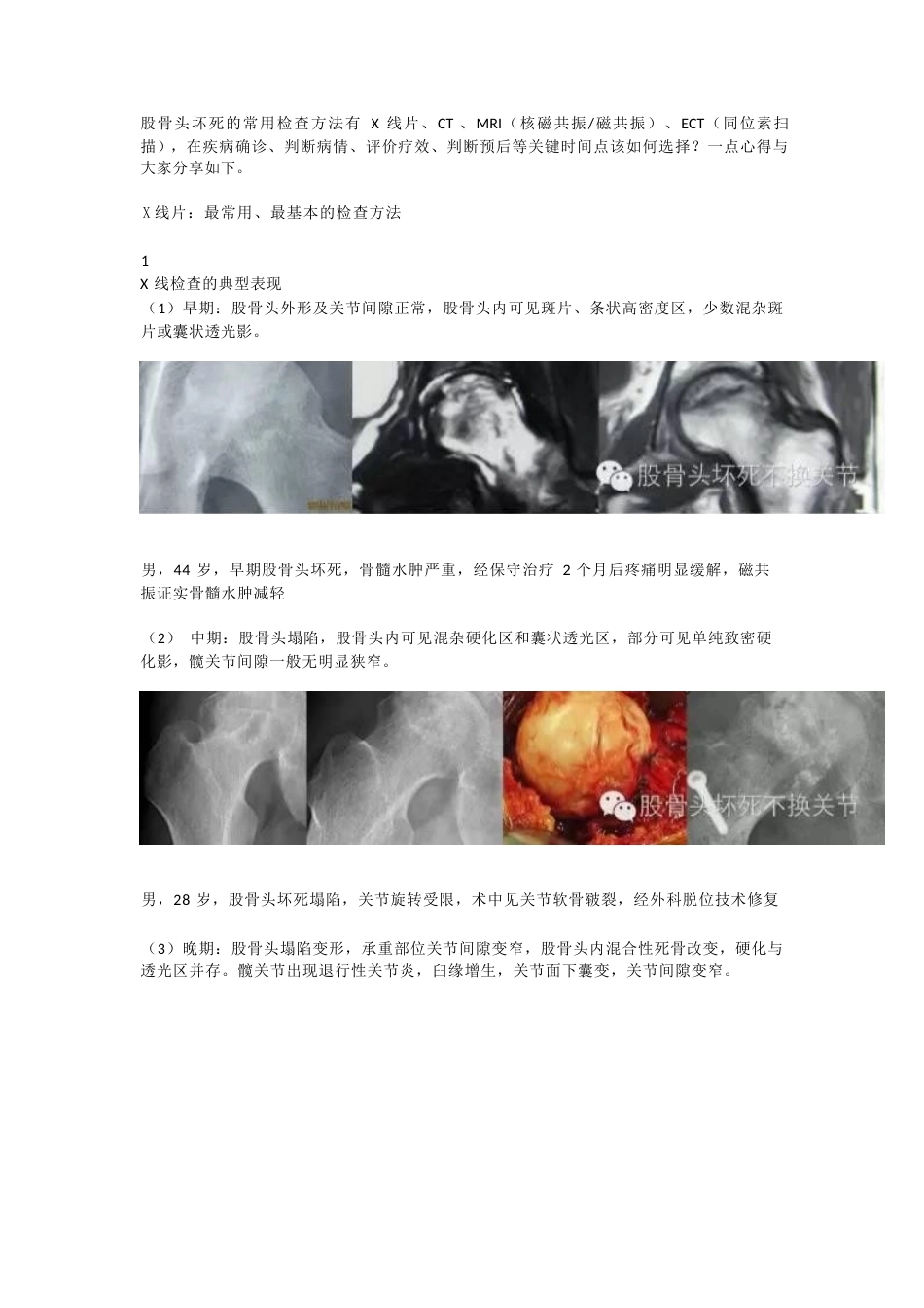 股骨头坏死应该怎样做检查(2)_第1页
