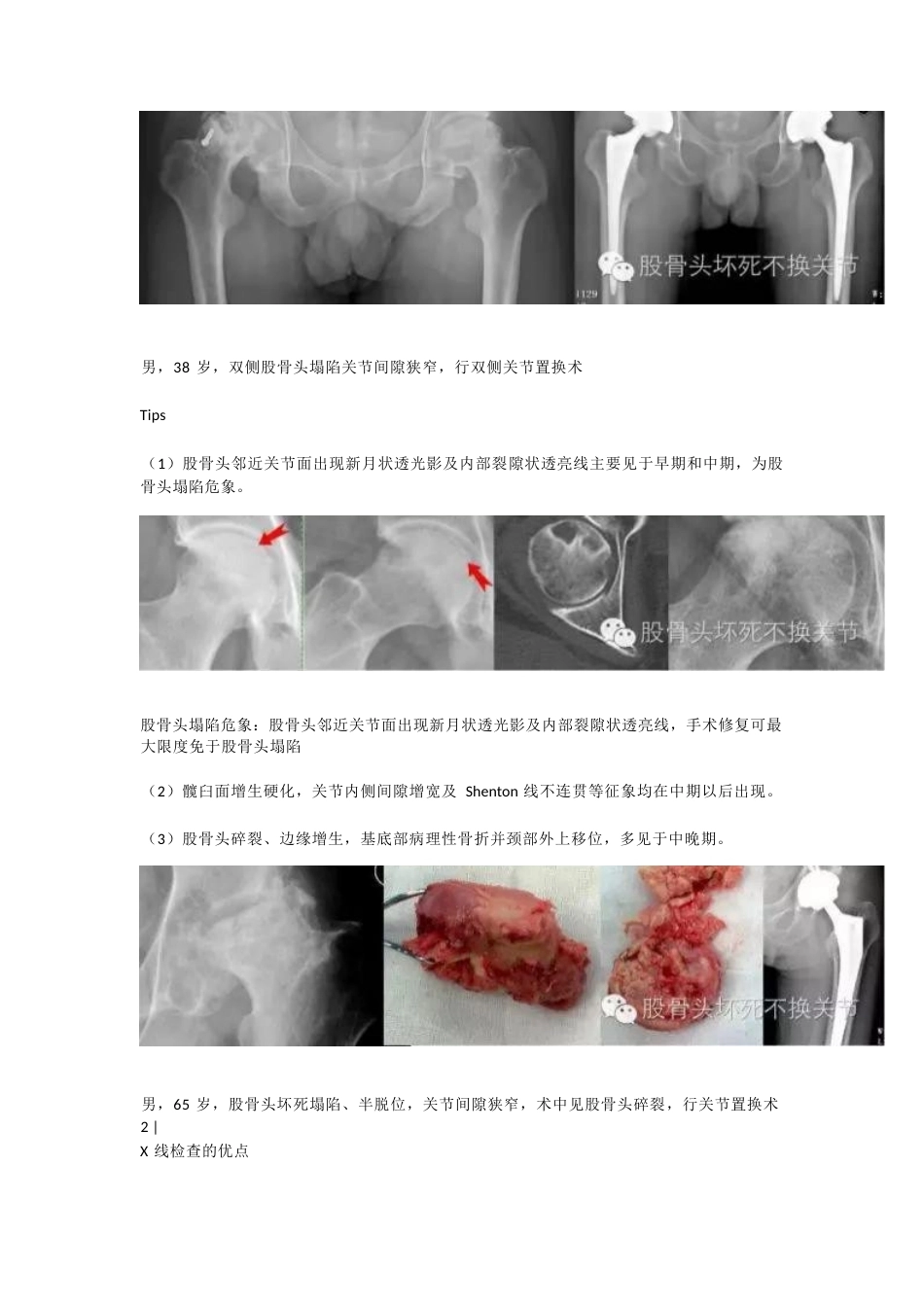 股骨头坏死应该怎样做检查(2)_第2页