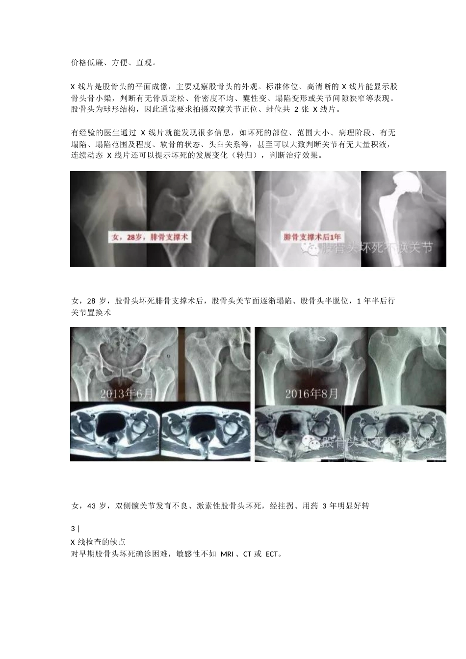 股骨头坏死应该怎样做检查(2)_第3页