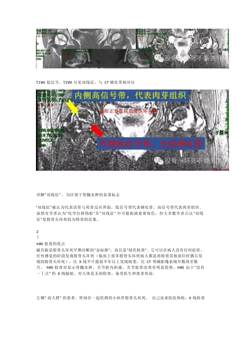 股骨头坏死应该怎样做检查(2)_第5页
