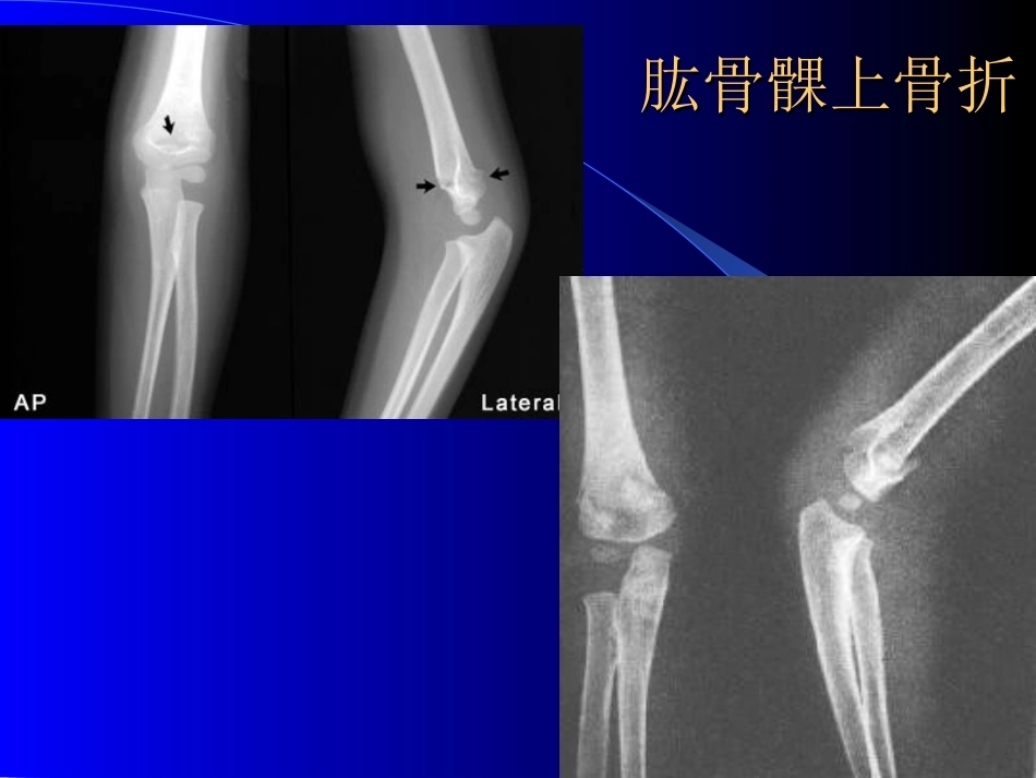 骨科常见疾病的X线表现(2)_第11页