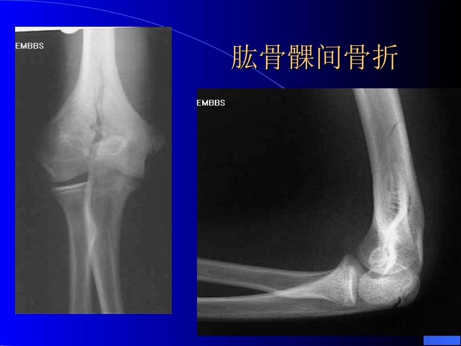 骨科常见疾病的X线表现(2)_第12页