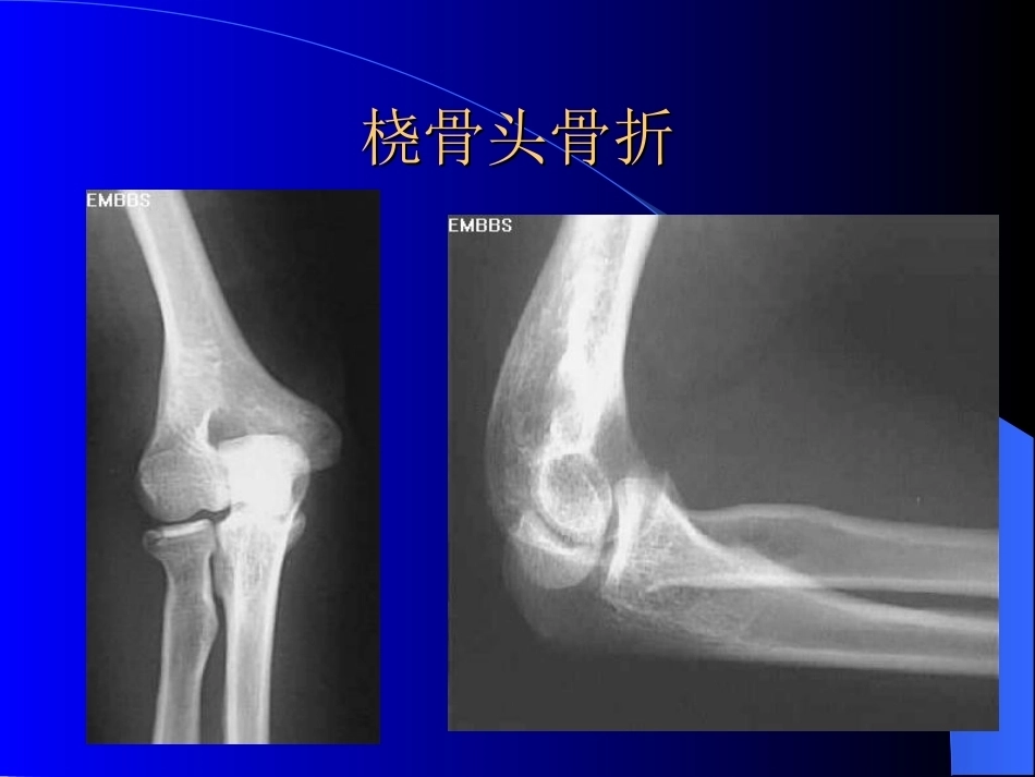 骨科常见疾病的X线表现(2)_第13页