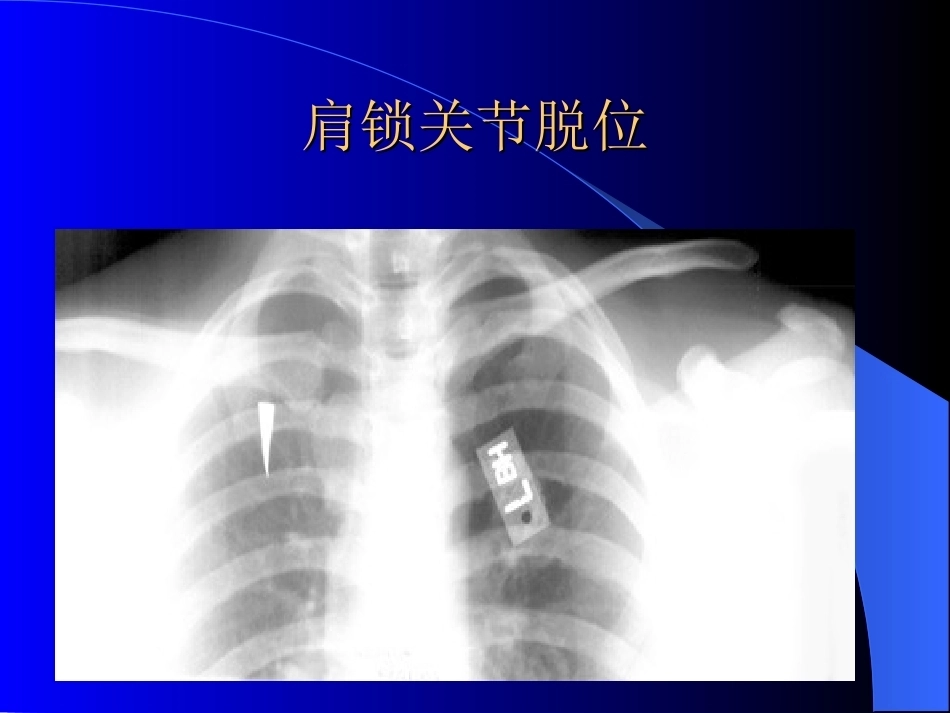 骨科常见疾病的X线表现(2)_第5页