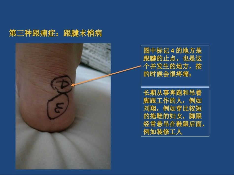 跟痛症课件(2)_第11页