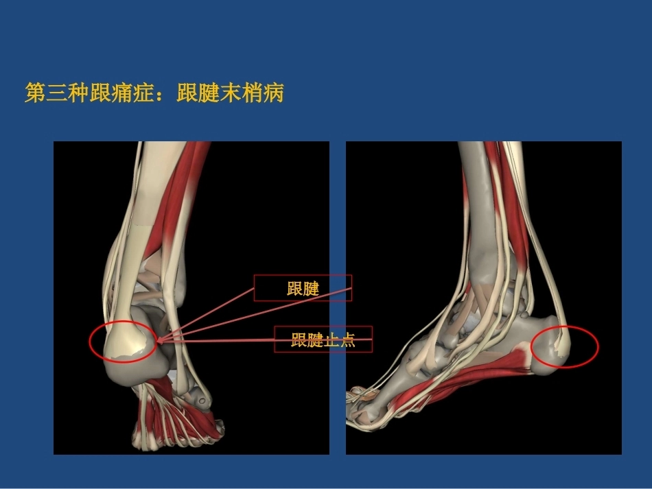 跟痛症课件(2)_第12页