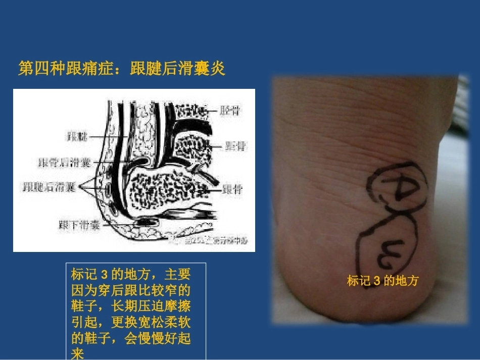 跟痛症课件(2)_第15页