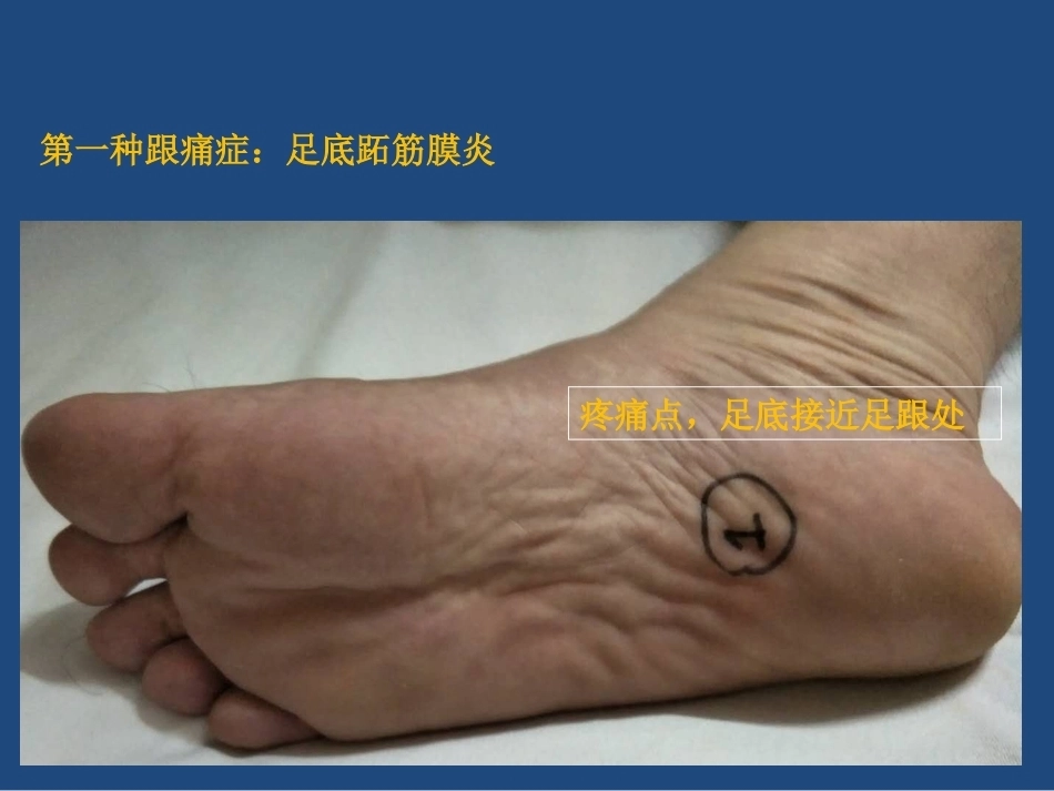 跟痛症课件(2)_第2页