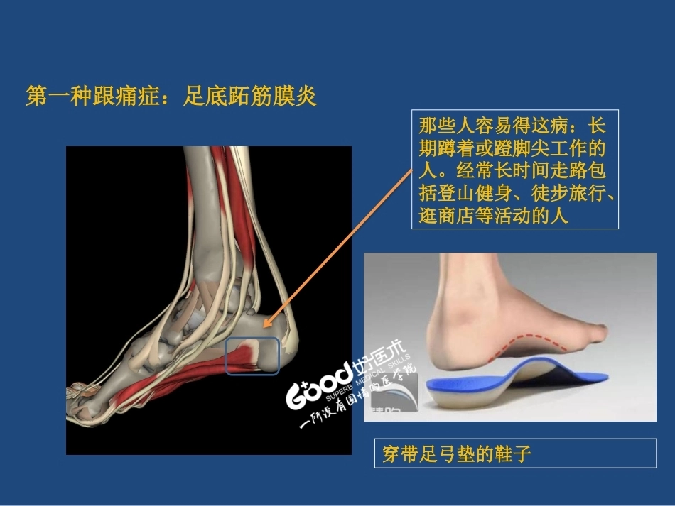 跟痛症课件(2)_第4页