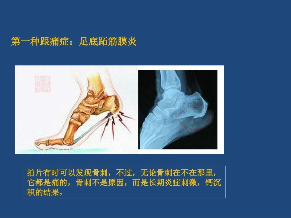 跟痛症课件(2)_第5页